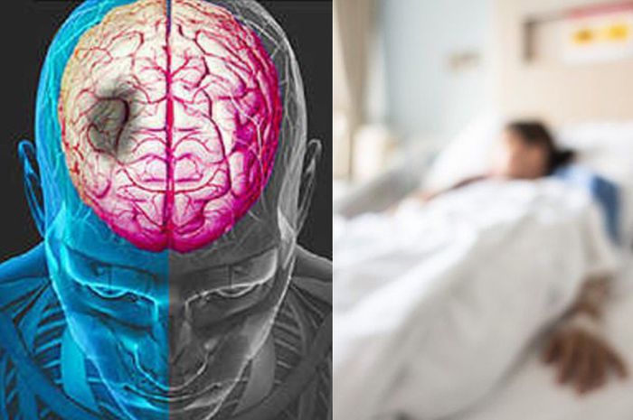 Studi: Golongan Darah A Lebih Rentan Terkena Stroke